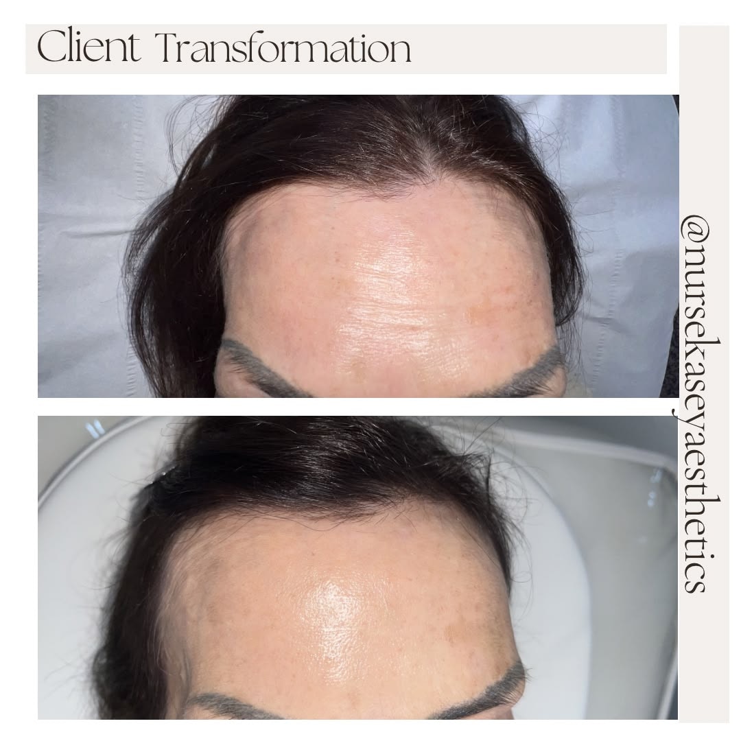 Client-supplied forehead before-and-after comparison 1, presented in its original collage