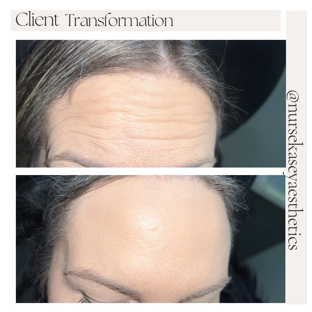 Client-supplied forehead before-and-after comparison 2, presented in its original collage