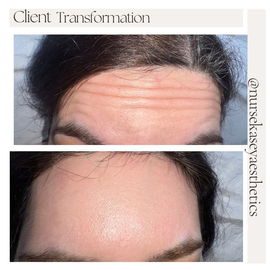 Client-supplied forehead before-and-after comparison 3, presented in its original collage