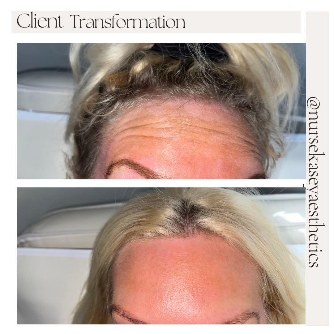 Client-supplied forehead before-and-after comparison 4, presented in its original collage