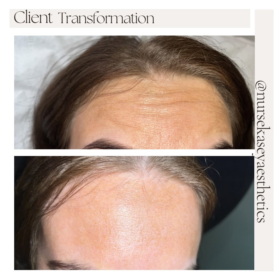 Client-supplied forehead before-and-after comparison 5, presented in its original collage