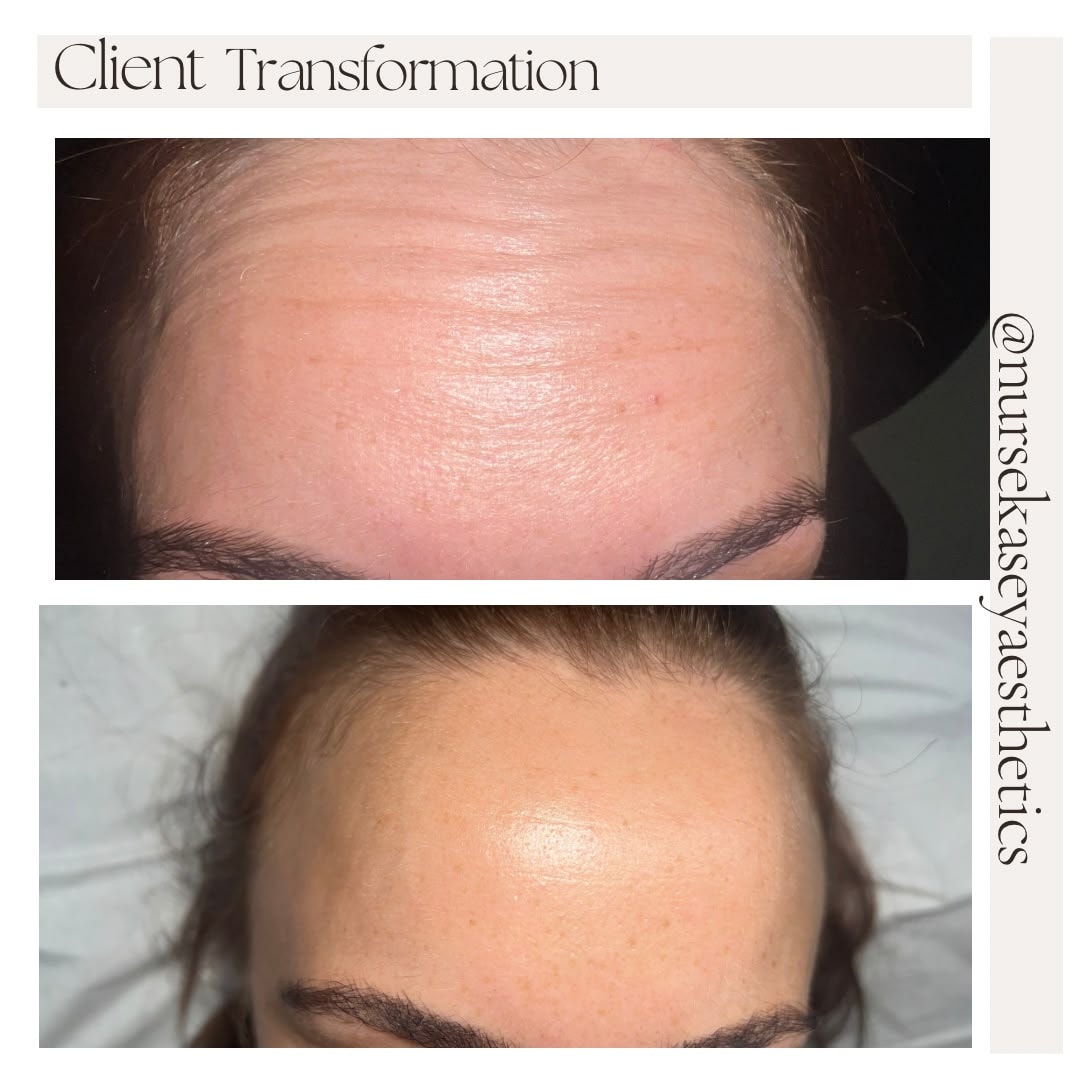Client-supplied forehead before-and-after comparison 6, presented in its original collage