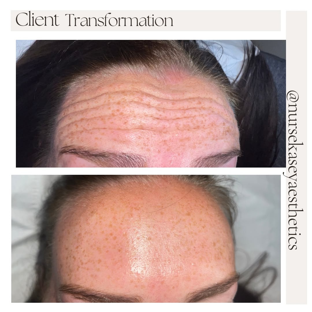 Client-supplied forehead before-and-after comparison 7, presented in its original collage