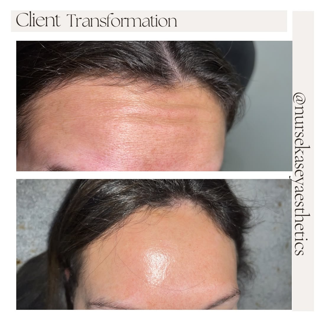 Client-supplied forehead before-and-after comparison 8, presented in its original collage