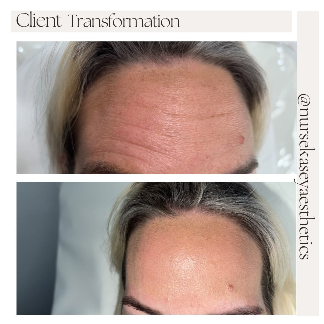 Client-supplied forehead before-and-after comparison 9, presented in its original collage