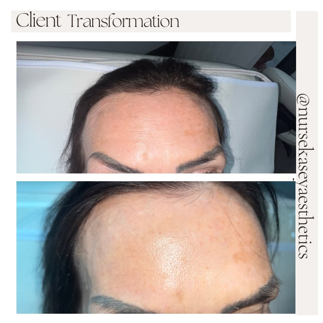 Client-supplied forehead before-and-after comparison 10, presented in its original collage