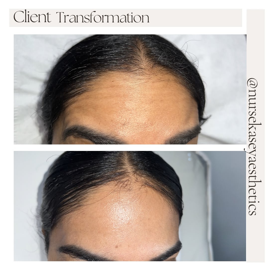 Client-supplied forehead before-and-after comparison 11, presented in its original collage